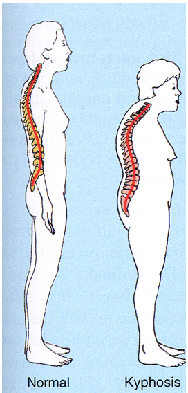 What is excessive thoracic kyphosis?