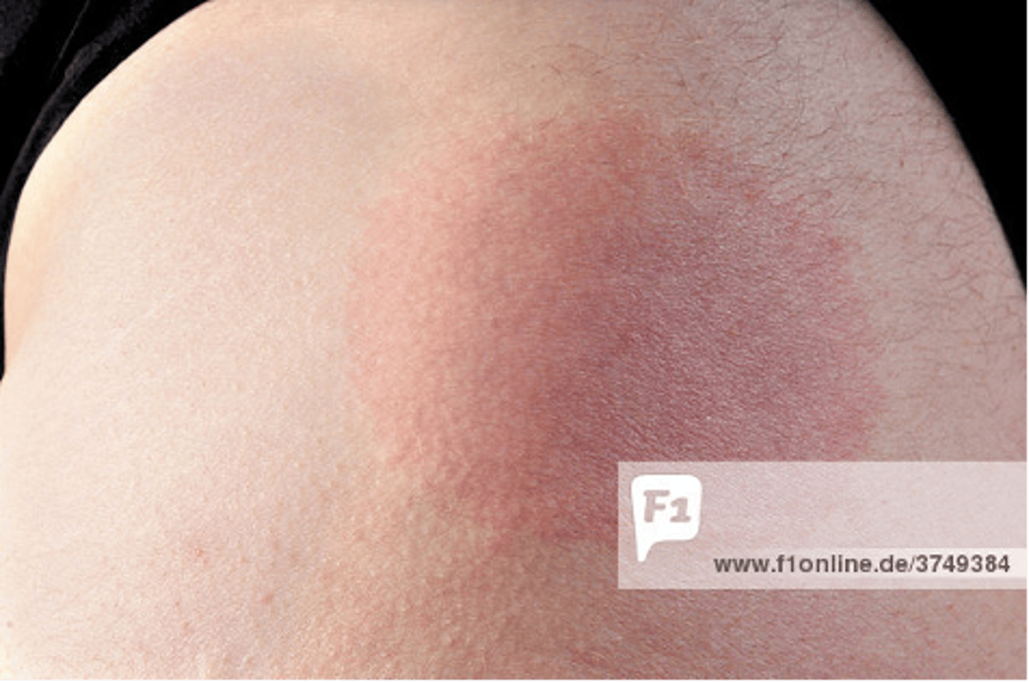 <p>1. early localized disease: erythema migraines</p><p>2. early disseminated disease: joints, heart (+), nervous system</p><p>3. late disease: lyme arthritis</p><p>dx: IgA and IgG</p><p>tx: doxy</p>