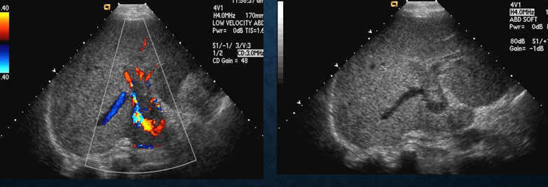<ul><li><p>enlarged vein with echoes</p></li><li><p>lack of flow by CDV/CDE </p></li></ul><p></p>