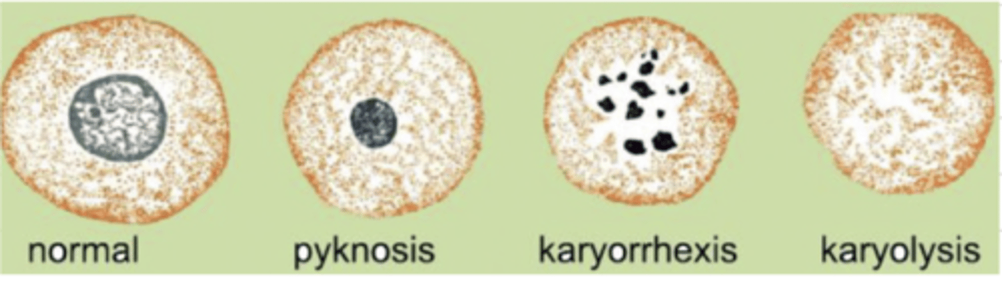 <p>-pyknosis: shrunken, dark, homogenous, round</p><p>-karyorrhexis: ruptured, dark fragments in cytoplasm</p><p>-karyolysis: pale due to dissolution of chromatin</p><p>-absence of nucleus: later stage of karyolysis</p>