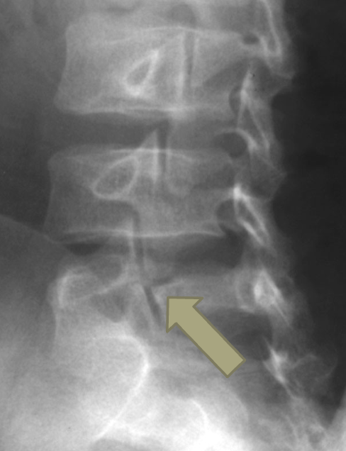 <p>Name this pathology</p>