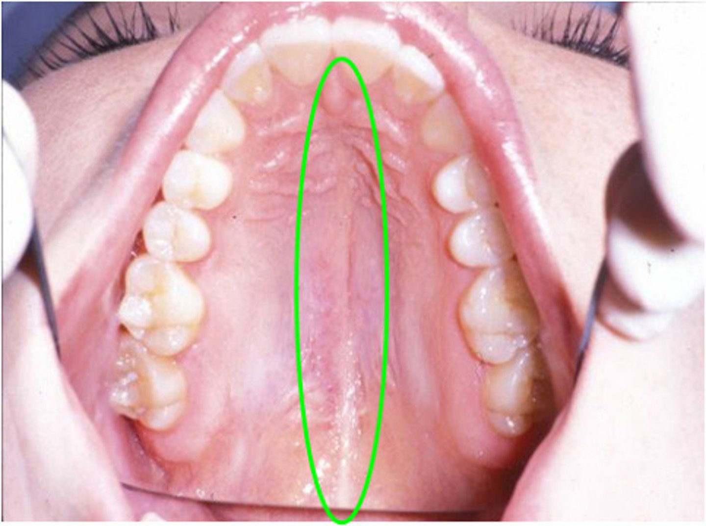 <p>Raphe running across the palate from the palatine uvula to the incisive papilla</p>