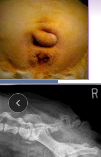 <ul><li><p><strong>Caudectomy (Tail docking): </strong>Cosmetic, trauma, neoplasia</p><ul><li><p><span style="color: rgb(136, 136, 136);"><strong>Puppies 3-5d: </strong></span><strong><u>local anesthesia</u></strong></p></li><li><p><span style="color: rgb(136, 136, 136);"><strong>Adults:</strong></span><strong> </strong><u>general anesthesia, ligation, V-incision closure</u></p></li></ul></li><li><p><strong>Episioplasty: </strong>Vulvar folds</p><ul><li><p><u>overweight dogs, younger recessed vulva </u></p></li></ul></li><li><p><strong>En-bloc resection: </strong>Tail folds</p><ul><li><p>Bulldogs</p></li><li><p><u>Redundant skin overlaps a deformed terminal </u></p><p><u>caudal vertebrae & prone to 2ndary infections</u></p></li></ul></li></ul><p></p>