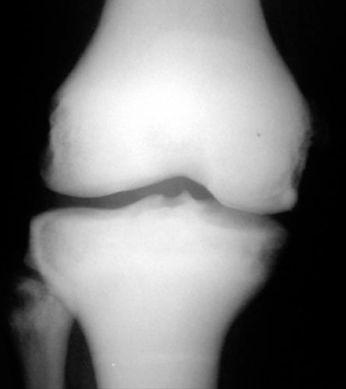 <p>Inherited function of a decreased osteoclastic activity (greek: petros “rock”) can be AD or AR (fatal) </p><p>INCREASE in bone density</p>