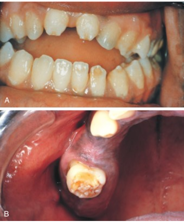 <ul><li><p>another infective teratogen</p></li><li><p>bacterial spirochete causing treponema pallidum</p></li><li><p>produces defects in incisors (hutchinson incisor) and molars (mulberry molar)  as well as blindness, deafness, and possible paralysis if not treated </p></li></ul><p></p>