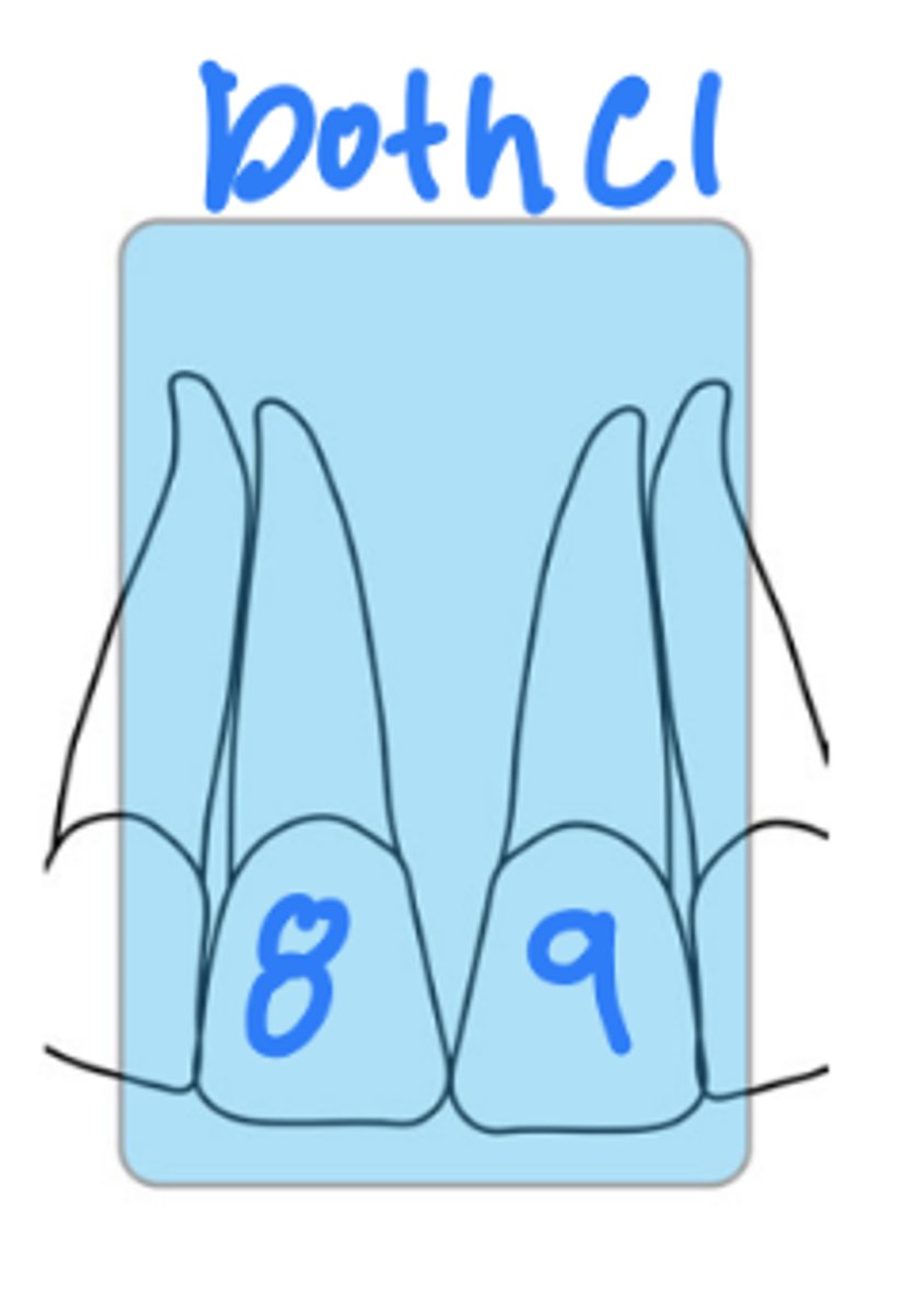 <p>size 1</p><p>mx right and left central incisors</p>