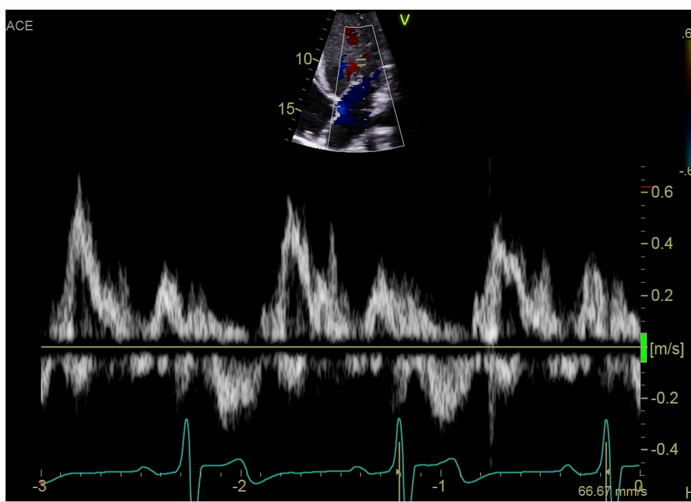 <p>Obtain a PW doppler for MV inflow </p>