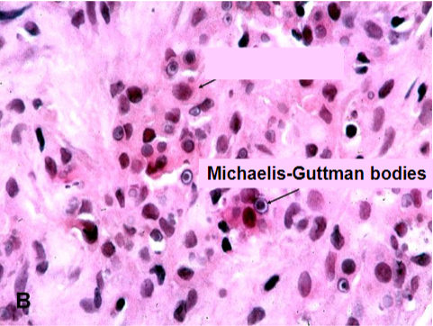 <p>Malakoplakia</p><p>concentrically layered Michaelis-Guttman bodies</p>