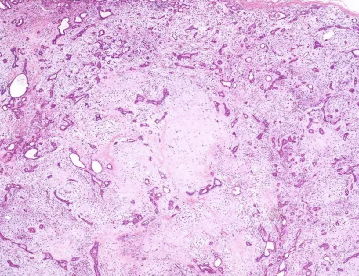 <p>Patient de 40 ans, gonflement parotide</p><p>1) Diagnostic</p><p>2) Epidémiologie (fréquence, âge) </p><p>3) Macro</p><p>4) Histo </p><p>5) IHC </p><p>6) Moléculaire</p>