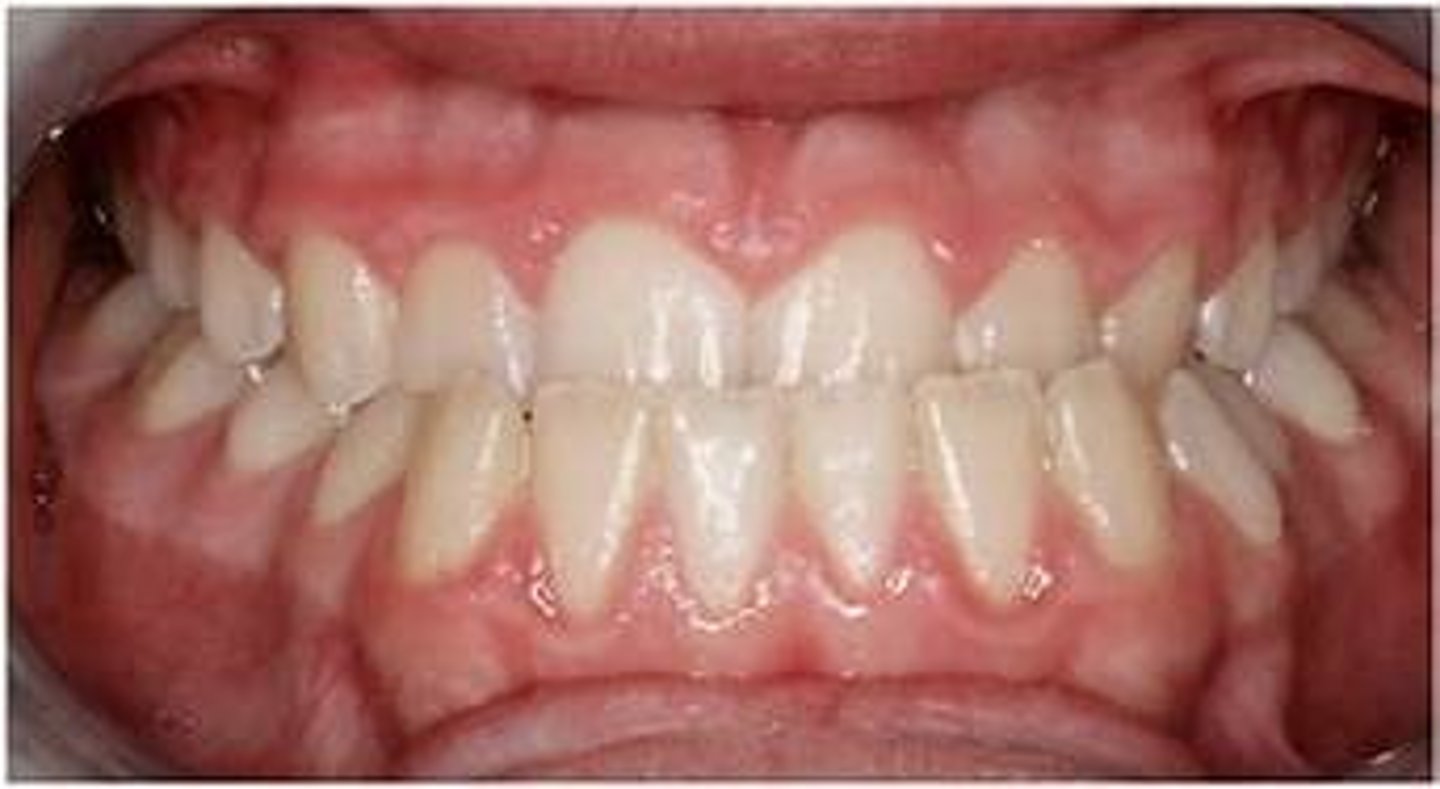 <p>Choose the best description for anterior crossbite.</p>