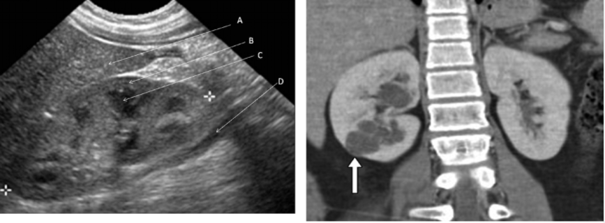 <ol><li><p>Abdominal Ultrasound</p></li><li><p>CT scan for:</p><ol><li><p>primary tumor </p></li><li><p>lymph nodes</p></li><li><p>possible lung mets</p></li></ol></li></ol><p></p>