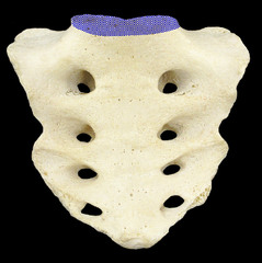 Where the first sacral vertebrae bulges into pelvic cavity