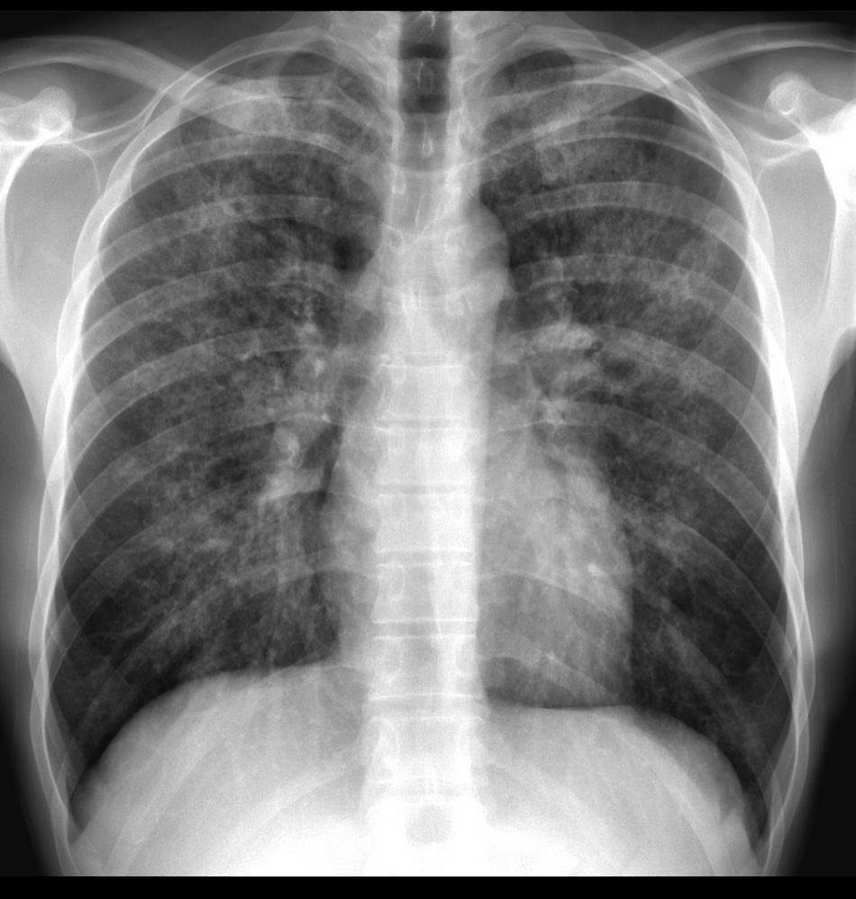 <p>dyspnea, hypocia, reticulonodular opacities</p><p>hiv+</p>