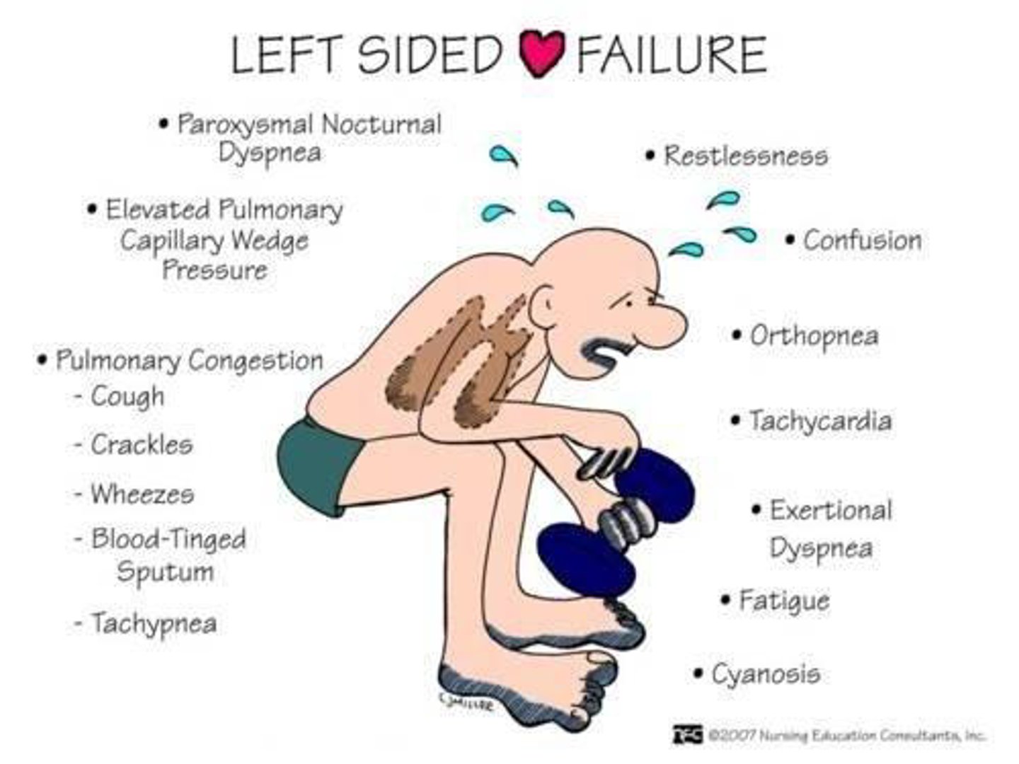 <p>the left ventricle fails</p><p>- left ventricle cannot accept or eject blood delivered from the lungs</p><p>- increases the blood volume in the lungs</p><p>- leads to pulmonary congestion and edema</p><p>- symptoms: dyspnea, orthopnea (dyspnea when laying), cough from pulmonary congestion</p>