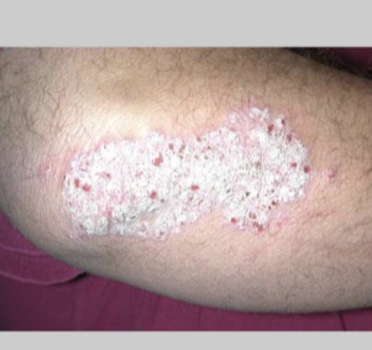 <p>elevated flat-topped area, > 5 mm across</p>