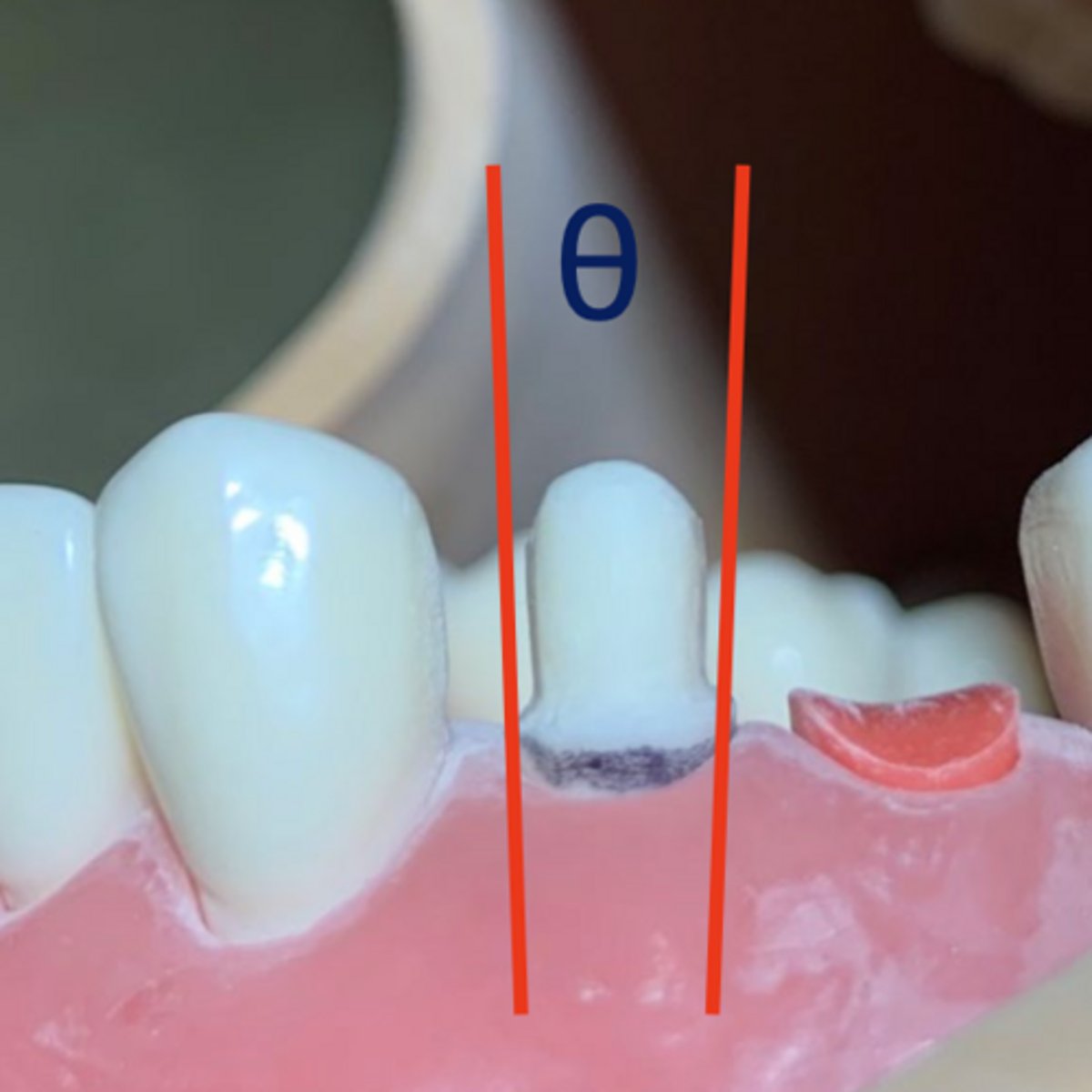 <p>What is wrong with the tooth prep on #5?</p>