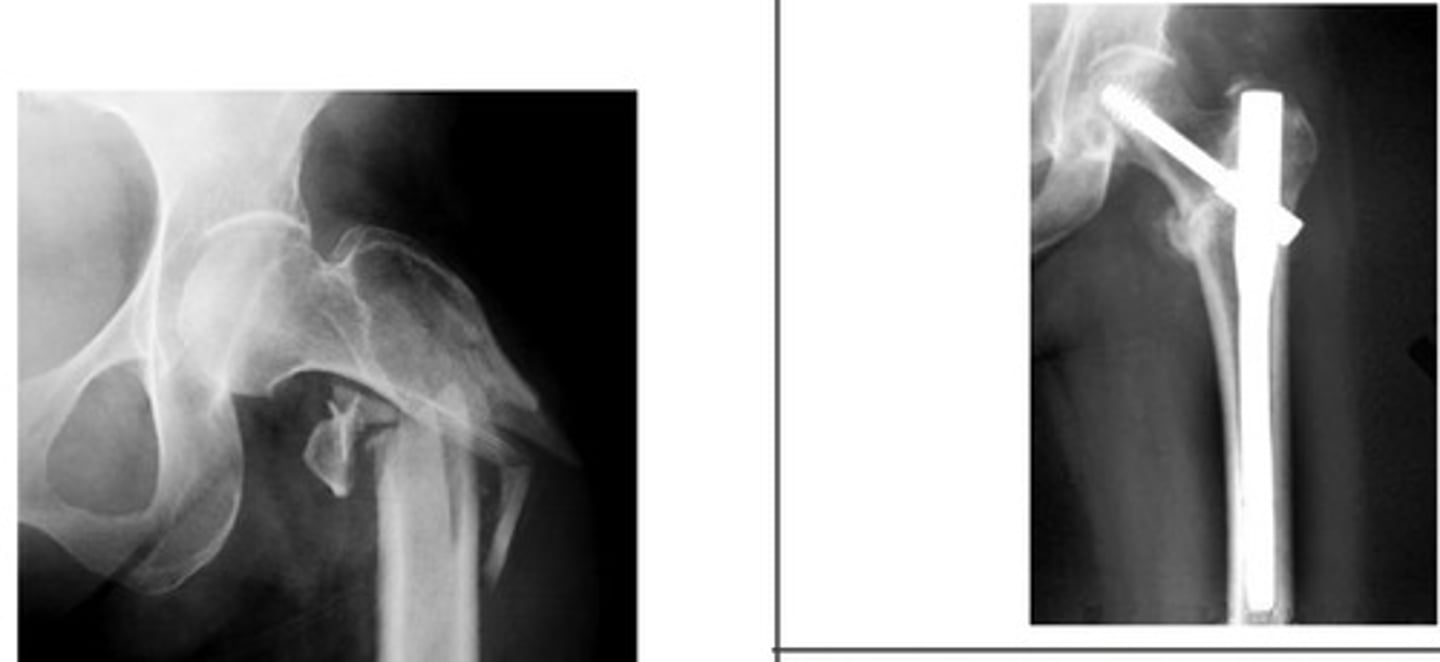 <p>What type of hip pinning is shown?</p>