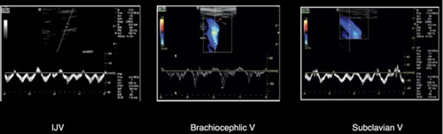 <p>Respirophasic</p><p>Cardiac Pulsatility</p><p>Diminished phasicity</p>