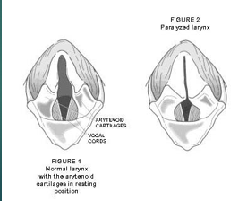 <p>Polyneuropathy </p>