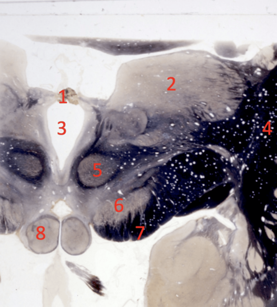 <p>posterior commissure</p>