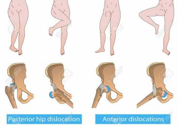 <p><strong>Hip Dislocation: Background</strong></p><p>-Types</p><ul><li><p>___________ is most common</p></li><li><p>Anterior</p></li><li><p>Inferior</p></li></ul><p>-Mechanism of Injury</p><ul><li><p>Posterior → significant force on ______ hip and knee</p></li><li><p>Anterior → forced ________ rotation of an __________ hip</p></li></ul><p>-Commonly associated with fractures of the __________, femur, or ____</p>