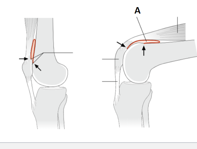 <p><span>The Recessus Suprapatellaris (A) is a redundant fold above the patella that provides a reserve capacity for knee flexion.</span></p>