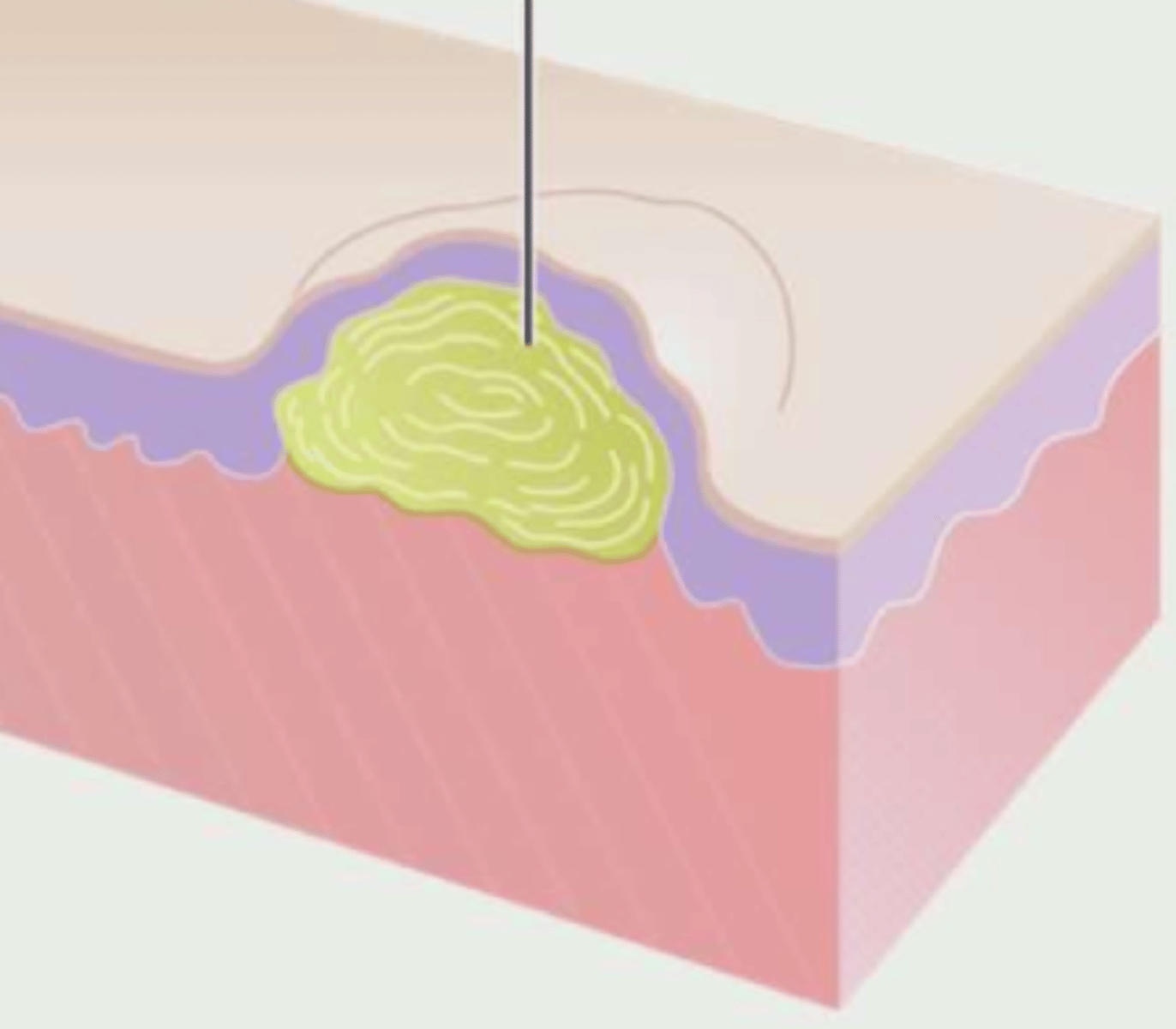 <p>¿lesión?</p><p>¿primaria o secundaria?</p>