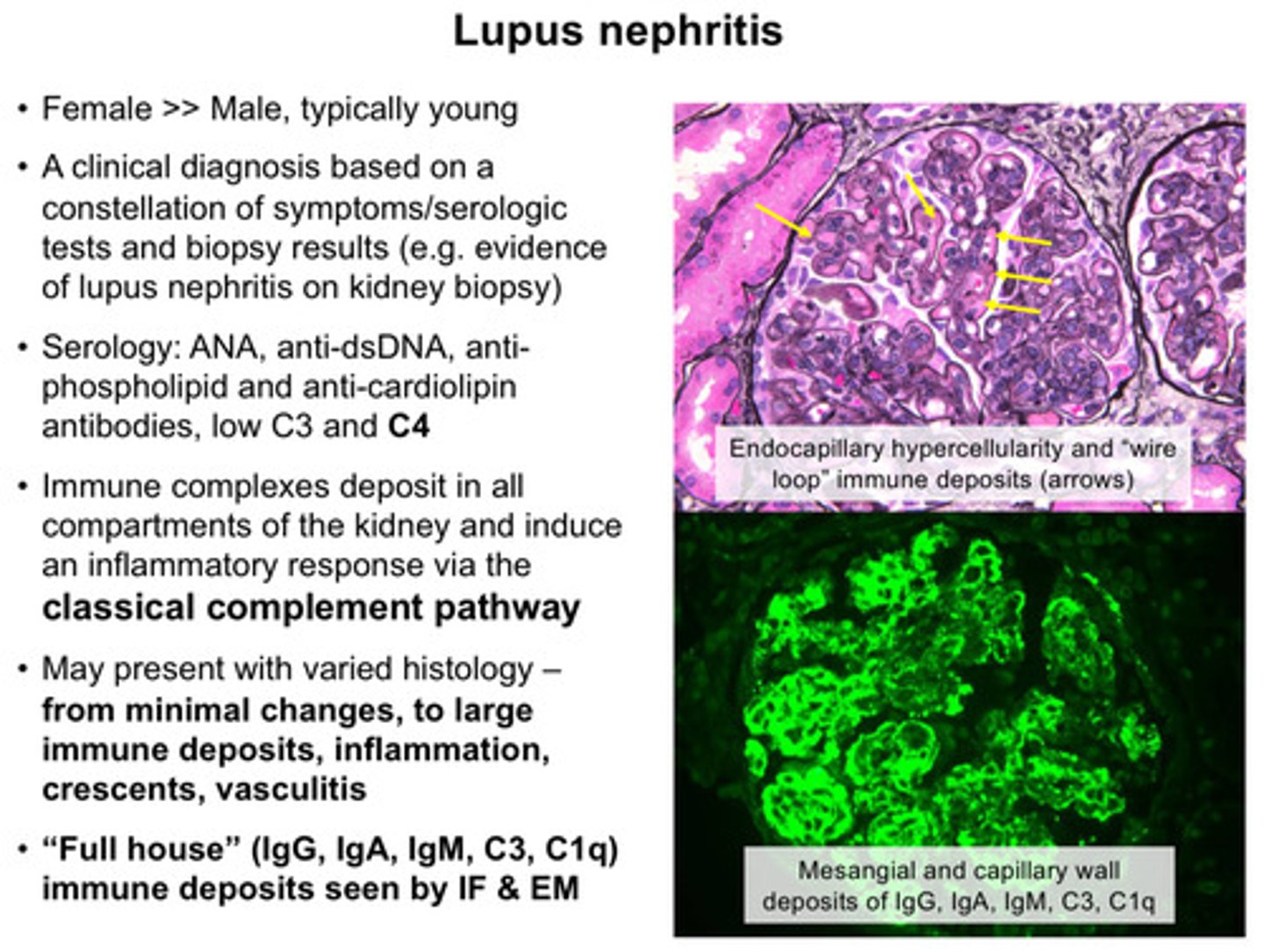 <p>1) female &gt; male; typically young</p><p>2) clinical diagnosis is based on a constellation of symptoms/serologic tests and biopsy results (eg: evidence of lupus nephritis on kidney biopsy)</p><p>3) serology: ANA, anti-dsDNA, antiphospholipid and anti-cardiolipin antibodies, low C3 and C4</p><p>4) immune complexes deposit in all compartments of kidney and induce an inflammatory response via the classical complement pathway</p><p>5) may present with varied histology: from minimal changes, to large immune deposits, inflammation, crescents, vasculitis</p>