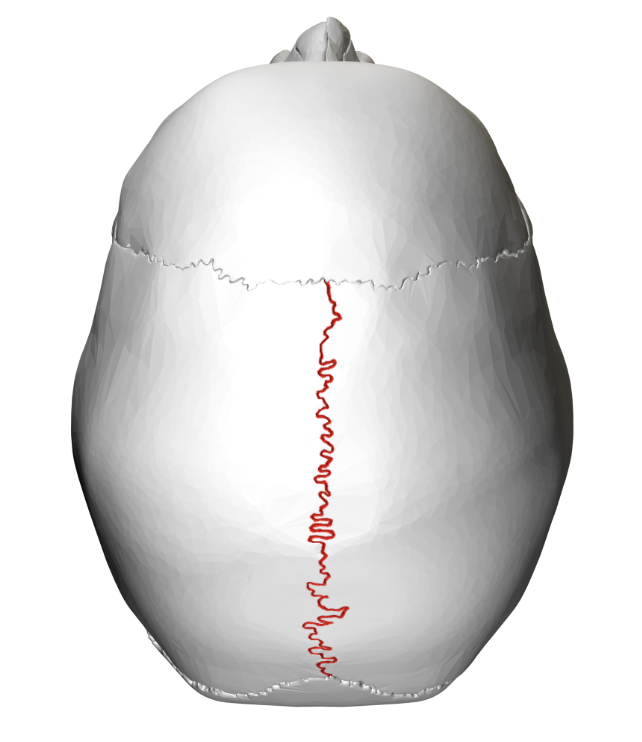 <p>Separates the right and left hald of the top of the skull</p>