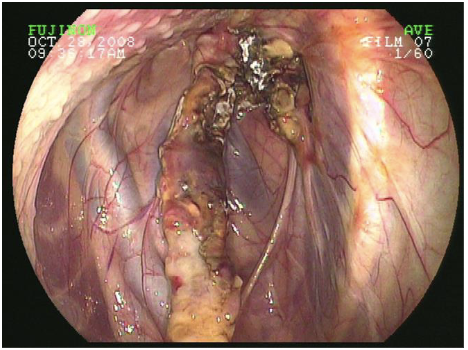 <p>guttural pouch mycosis</p>