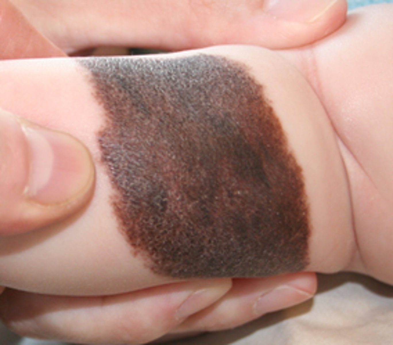 <p>-benign nevus present at birth or within first two weeks of life (1-2% worldwide)</p><p>-often flat and tan in color</p><p>-may change in color, become papillated, or display hair growth during first few years of life and can vary tremendously in size</p>