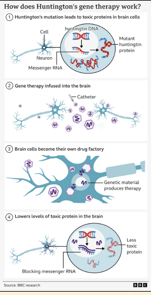 <p>Use microRNA to bind to huntingtin mRNA – reduce gene expression</p><p>Infused deep into the brain using real-time MRI scanning and a microcatheter: 12-18h neurosurgery</p><p>Results not published yet</p>