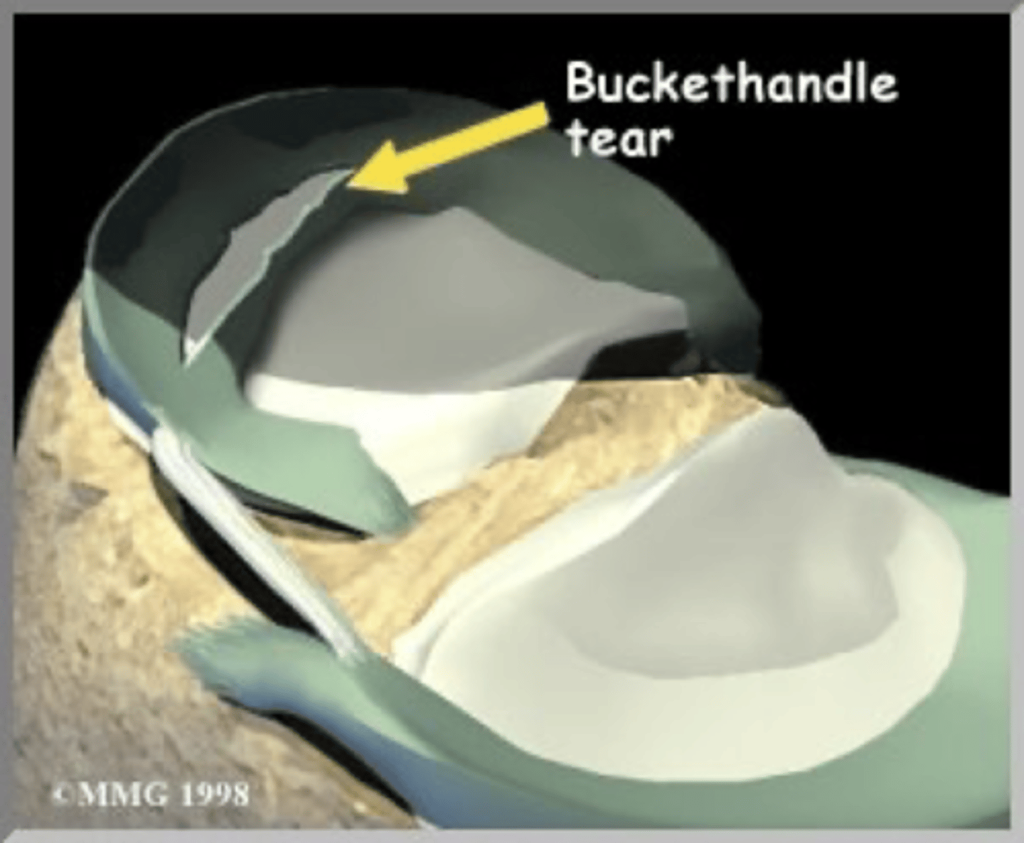 <p>the medial meniscus because it is larger and more tethered down</p>
