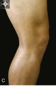 <p>Identify the fibular head. </p>