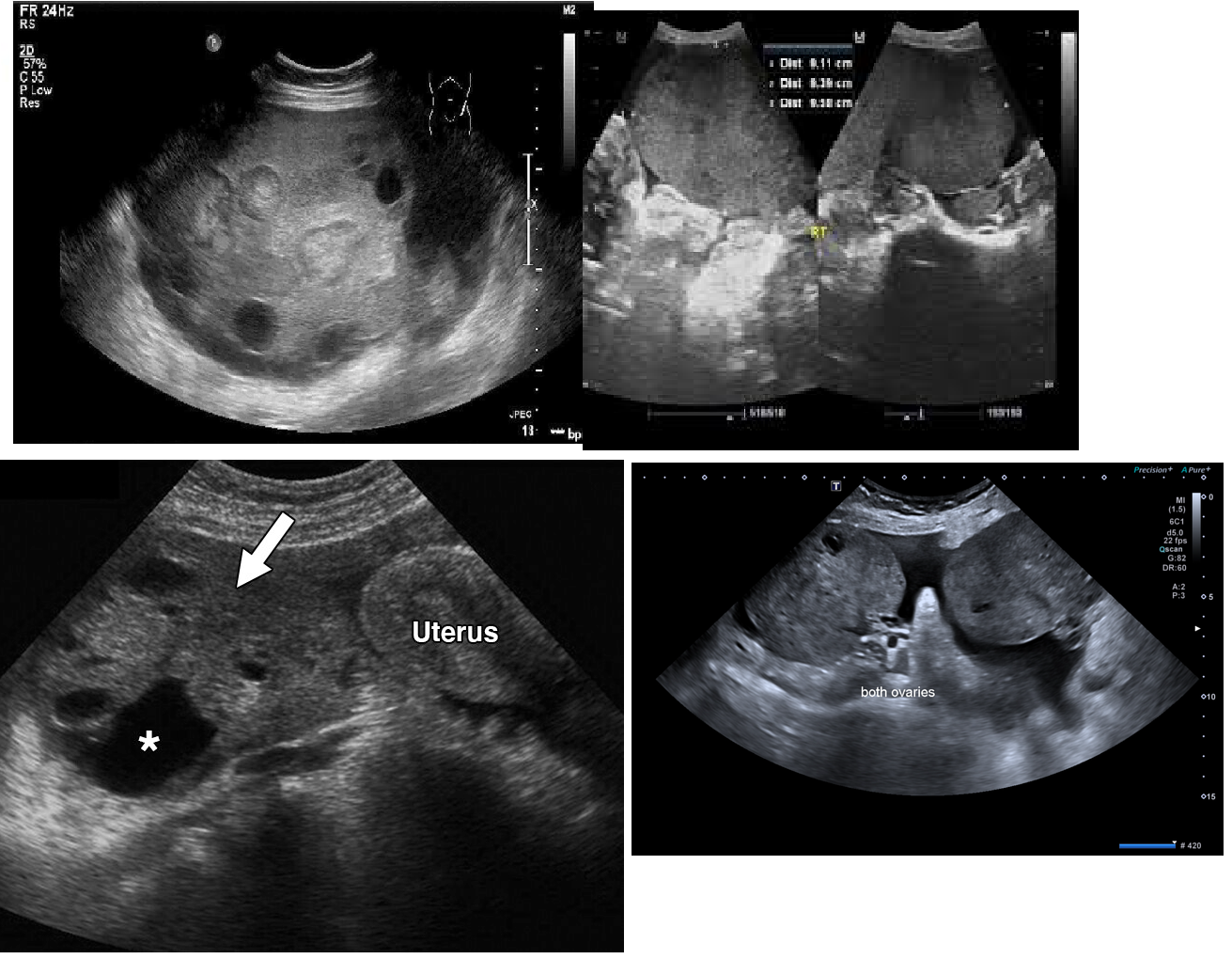 <p><span>Gastric adenocarcinoma with ovarian metastases</span></p>