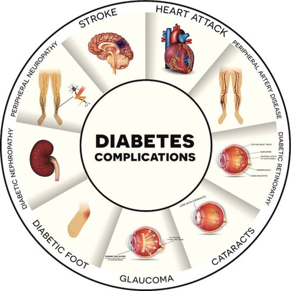 <p>microangiopathy:</p><p>-occlusion of small blood vessels -> peripheral vascular disease</p><p>-ischemia predisposes to infection (gangrene)</p><p>-amputation of lower limbs often required</p><p>-occlusion of coronary or carotid arteries and branches may lead to MI or stroke</p><p>-blindness</p><p>-kidney failure</p>