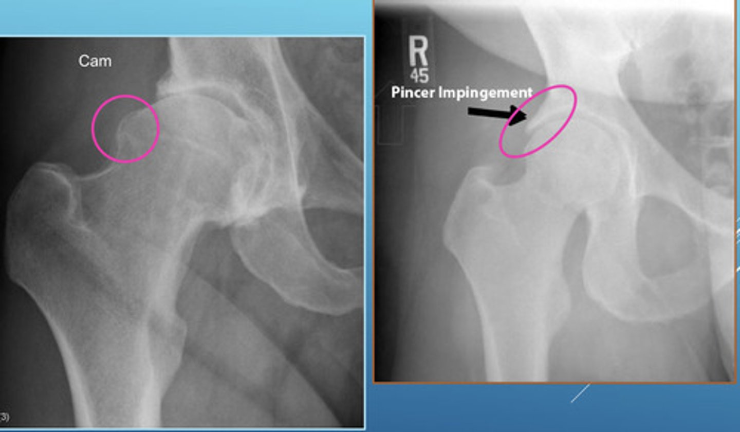 <p>(1) Pincer Morphology = overcoverage of the femoral head</p><p>(2) Cam Morphology = bump formation at the femoral neck and asphericity</p><p>Both can co-occur and can lead to FAI and predispose to early OA</p>