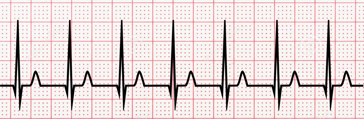 <p>name  ECG pattern</p>