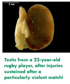 <ul><li><p>result of ischaemia leading to necrotic tissue infiltrated with extravasated red blood cells</p></li><li><p>ie. lung infarct with blood supply still present or torsion of the testis</p></li><li><p>trickle of blood into infarcted area</p></li></ul><p></p>
