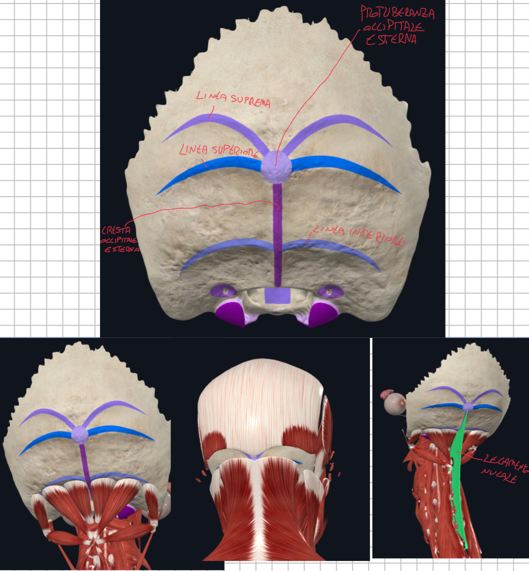 <p>Faccia Esterna della parte squamosa:</p><ul><li><p>Protuberanza occipitale esterna:</p><ul><li><p>è palpabile ed è usata come punto craniometrico detta Inion.</p></li><li><p>da qui si irradiano le linee nucali</p></li><li><p>dà attacco alla parte discendente del muscolo trapezio</p></li></ul></li><li><p>Cresta occipitale esterna: </p><ul><li><p>si estende inferiormente dalla protuberanza fino al forame magno</p></li><li><p>dà inserzione al legamento nucale</p></li></ul></li></ul><p>Linee Nucali:</p><ul><li><p>Superiore:</p><ul><li><p>Si estende dalla protuberanza occipitale esterna</p></li></ul><ul><li><p>Dividono la porzione cranica (sopra) da quella nucale (sotto)</p></li><li><p>Le sue inserzioni sono:</p><ul><li><p>Porzione mediale del trapezio</p></li><li><p>Muscolo semispinale della testa</p></li><li><p>Sternocleidomastoideo</p></li></ul></li></ul></li><li><p>Inferiore:</p><ul><li><p>Si estende dalla cresta occipitale esterna e si dirige verso il processo giugulare</p></li><li><p>Le sue inserzioni sono:</p><ul><li><p>Muscoli posteriori della testa come il grande e piccolo retto</p></li></ul></li></ul></li><li><p>Suprema:</p><ul><li><p>Talvolta presente, meno evidente</p></li><li><p>Sopra quella superiore</p></li><li><p>Inserzione per muscoli occipito-frontali quando presente, altrimenti questi originano dalla linea superiore</p></li></ul></li></ul><p></p>
