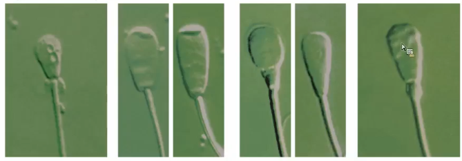 <p>What are some types of head abnormalities of sperm?</p>