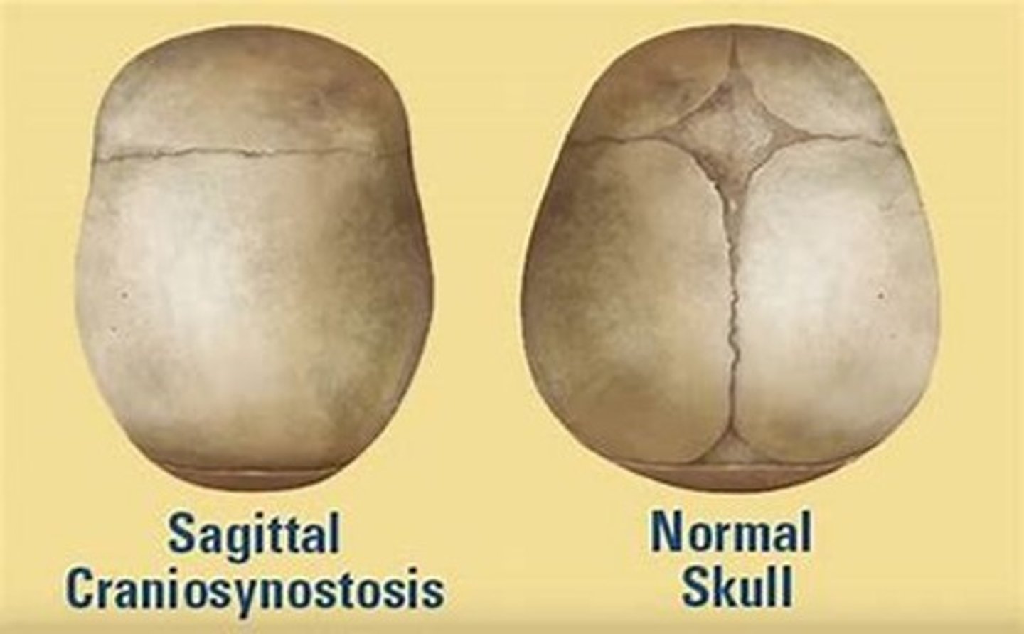 <p>premature fusion of fontanelles and cranial sutures can lead to cranial vault abnormalities</p>