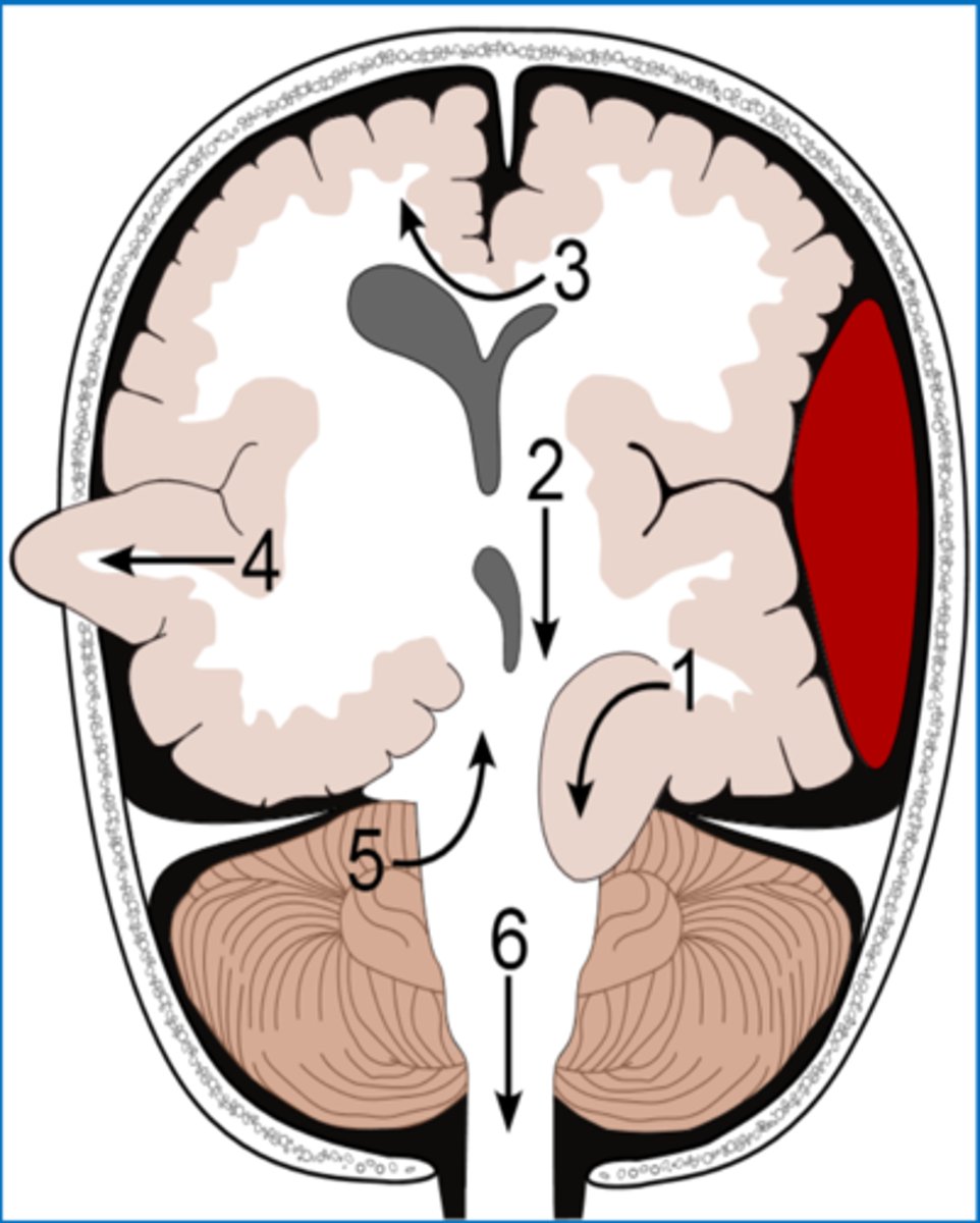<p>herniation in which brain matter is pushed past the tentorial membrane, which separates the cerebrum from the brainstem (1)</p>