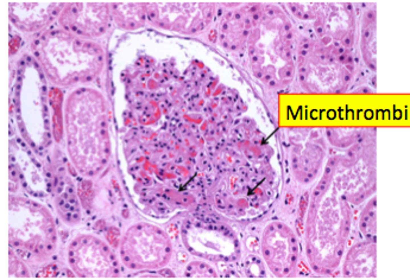 <p>- prolonged exposure to cold induces severe vasoconstriction and endothelial damage (no more hunting reflex, only vasoconstriction)</p><p>- promotes formation of microthrombi (obstructs circulation)</p>
