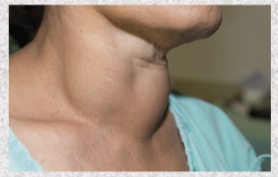 <p>autoantibodies mimic effect of TSH on thyroid, causing thyroid hypersecretion</p>