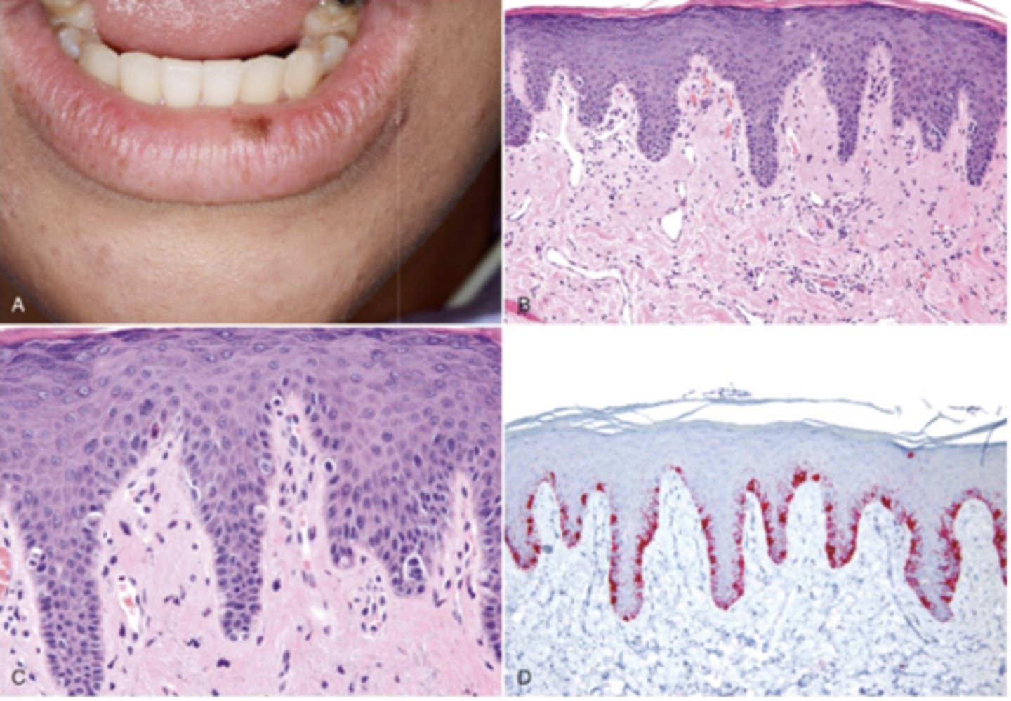 <p>What type of pigmented lesion?</p>