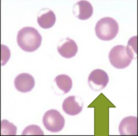 <ul><li><p>appear to have hemoglobin pushed to one side</p></li><li><p>seen in patients with diabetes, neoplasia, babesia</p></li><li><p>can be due to toxicities </p></li></ul><p></p>