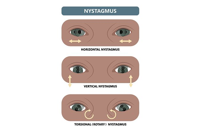 <p>When tone of one eye muscle is weak: Eye slowly drifts in one direction then quickly corrects itself. Controlled by <strong>vestibulo-ocular reflex</strong></p>