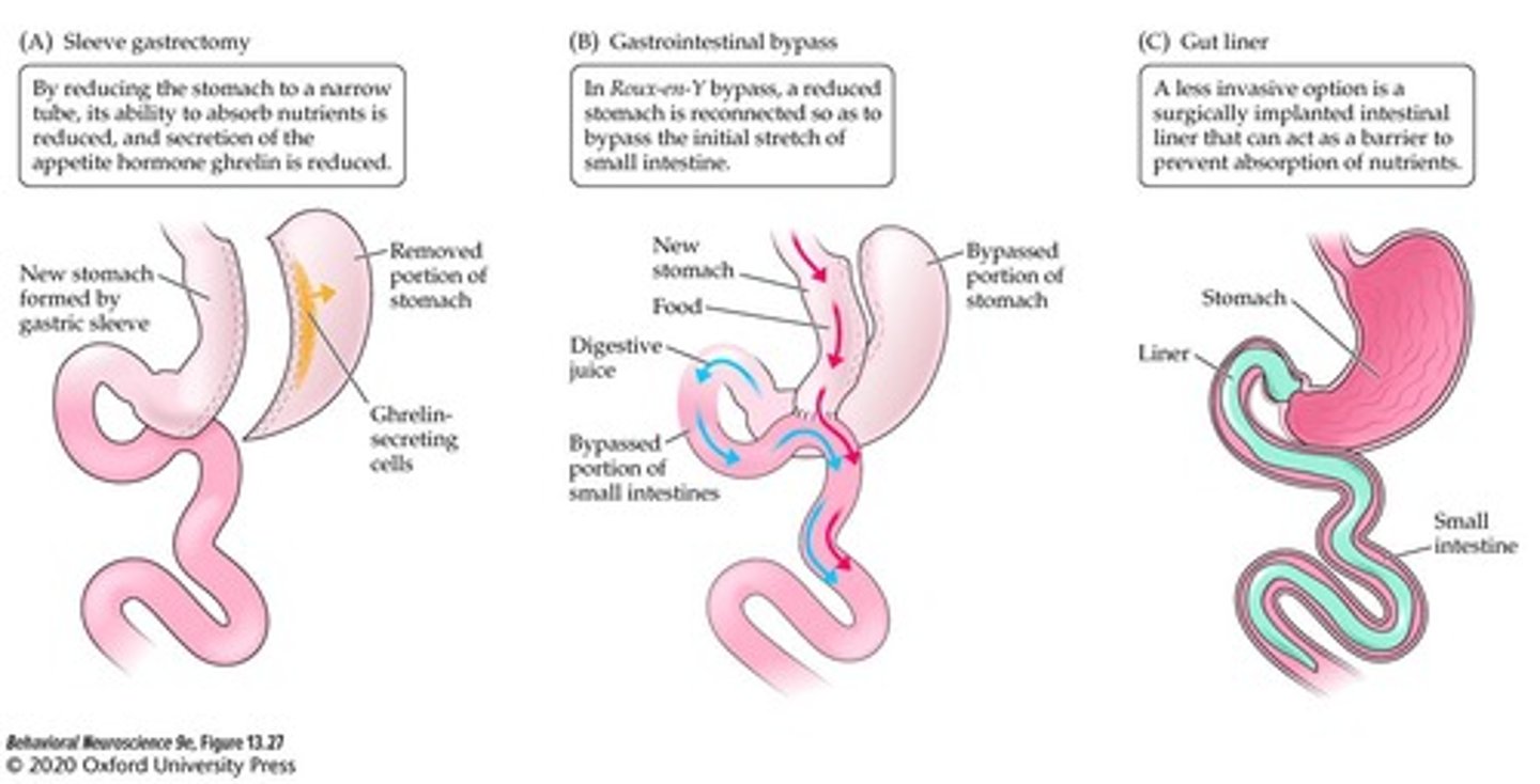 <p>To surgically reduce the stomach to a small pouch and connect it to the small intestine, bypassing part of the intestine to reduce nutrient absorption.</p>