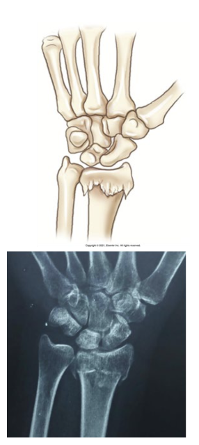 <p>One fragment is driven into the other, quite common with fall on outstretched hand (FOSH)</p>